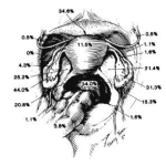 Can tubal ligation cause endometriosis