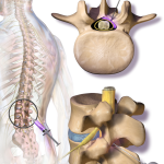 Can reversal be done with epidural?