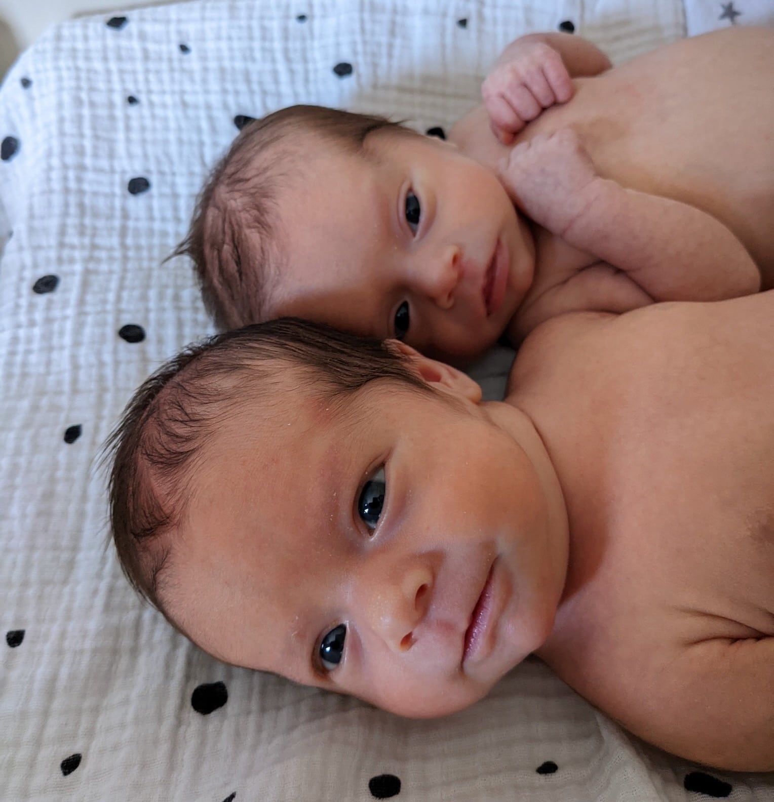 twin-girls-born-after-tubal-reversal-in-mother-with-endometrial-ablation