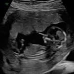 tubal-reversal-surgery-thornton-colorado-thirteen-weeks-pregnant